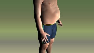 obesity